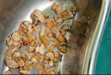 مصر.. استخراج 58 حصوة من كلية مريض في عملية نادرة بمستشفى المعبر الجامعي في قنا