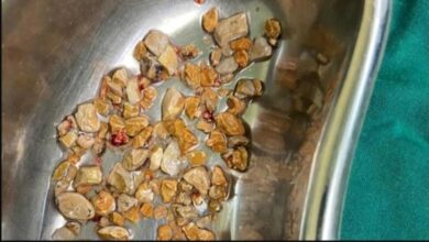 مصر.. استخراج 58 حصوة من كلية مريض في عملية نادرة بمستشفى المعبر الجامعي في قنا 3 مصر.. استخراج 58 حصوة من كلية مريض في عملية نادرة بمستشفى المعبر الجامعي في قنا