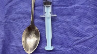 مصر.. الأطباء أصيبوا بالدهشة، إنقاذ حياة مسنة ابتلعت "ملعقة شاي" بالمنوفية