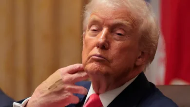 ترامب يبرر الكدمات بتناول الأسبرين ويؤكد تمتعَه بصحة «ممتازة»