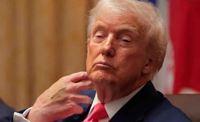 ترامب يبرر الكدمات بتناول الأسبرين ويؤكد تمتعَه بصحة «ممتازة» 1 ترامب يبرر الكدمات بتناول الأسبرين ويؤكد تمتعَه بصحة «ممتازة»